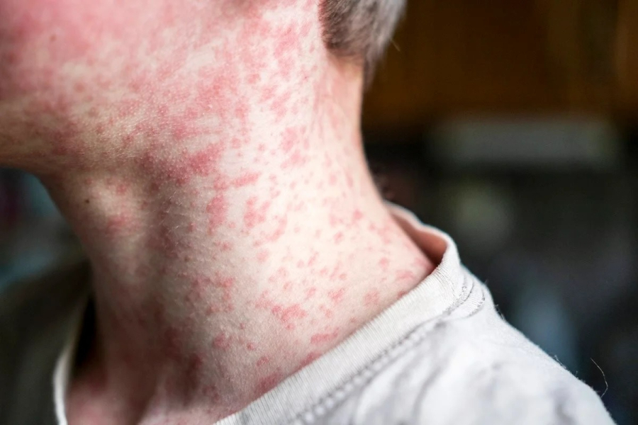 Nova York decreta estado de emergência devido a surto de sarampo; EUA registram pior índice em 35 anos